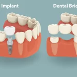Illustration Comparing Dental Implant And Dental Bridge Solutions For Missing Teeth At A Surat Dental Clinic 2