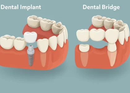 Illustration Comparing Dental Implant And Dental Bridge Solutions For Missing Teeth At A Surat Dental Clinic 2