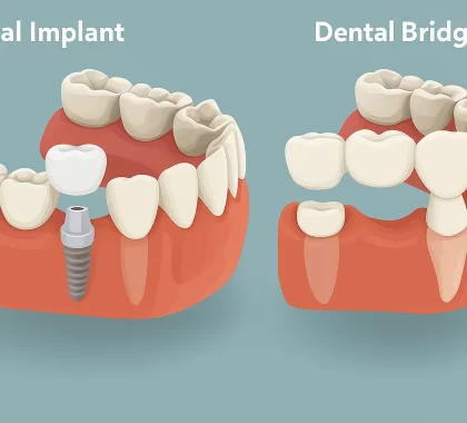 Dental Implants vs Bridges: Which Is Right For You?
