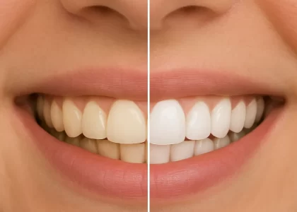 Before And After Tooth Whitening Comparison Showing Yellowish Teeth On The Left And Bright White Teeth On The Right Illustrating Professional Dental Whitening Results In Surat