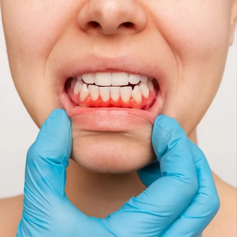 Dr Teeth Gum Problems Dr Payal Devani Khunt Gum Infections Problem solving in Mota Varachha Surat