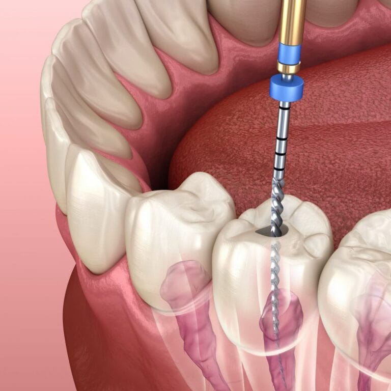 Root Canal Treatment RCT in Mota Varachha Surat