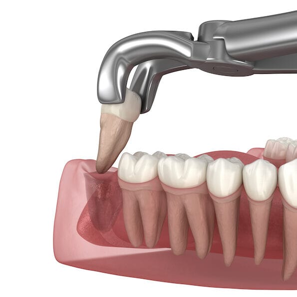 Extraction of wisdom tooth. Medically accurate tooth 3D illustration.
