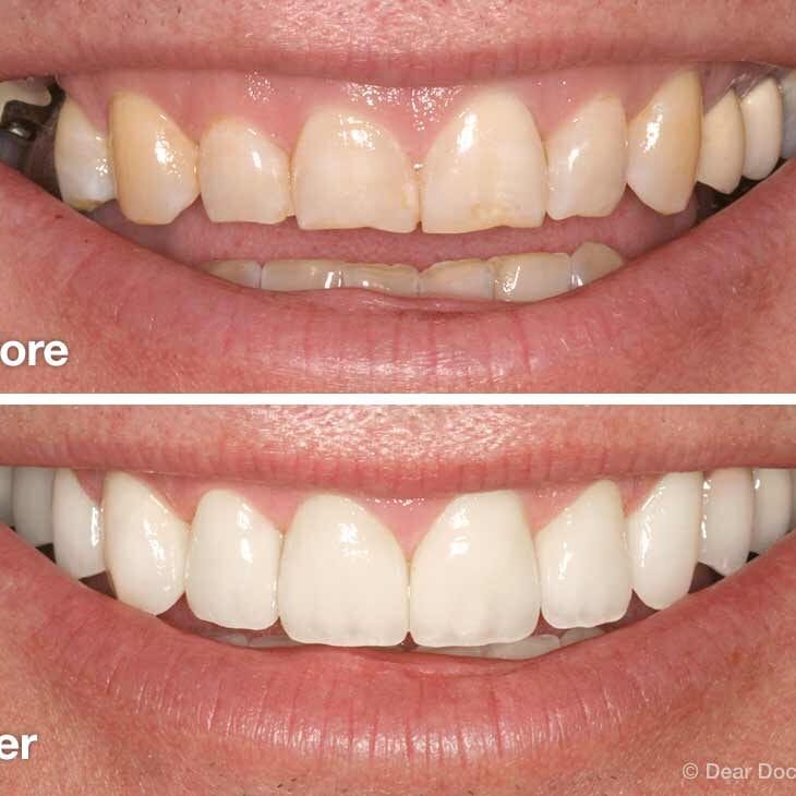 Best Dental Smile Makeover | Full Mouth Rehabilitation in Mota Varachha Surat