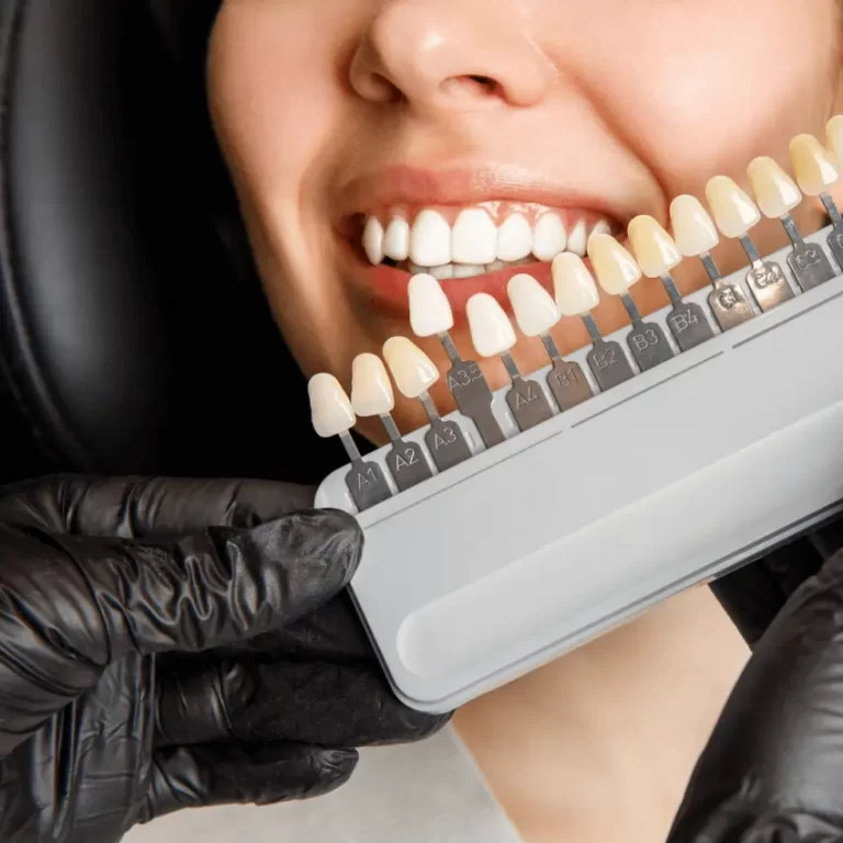 Types Of Dental Veneers 1280x853 2