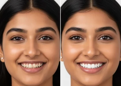 Before And After Smile Makeover Results Of A Young Indian Woman Showing Improved White Aligned Teeth At Dr Teeth Luxury Dental Surat Mota Varachha